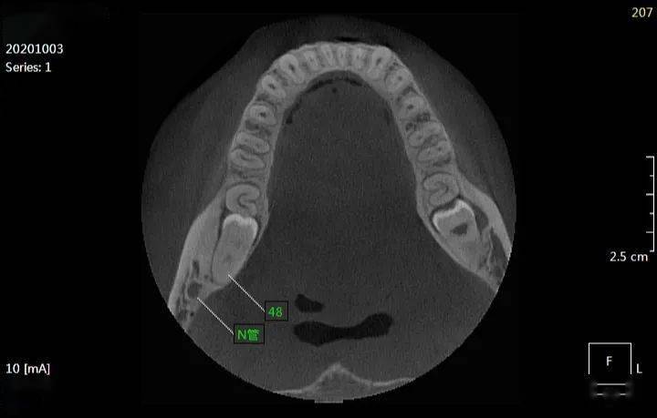 刘xx 20201003 智齿cbct 182xxxx2992