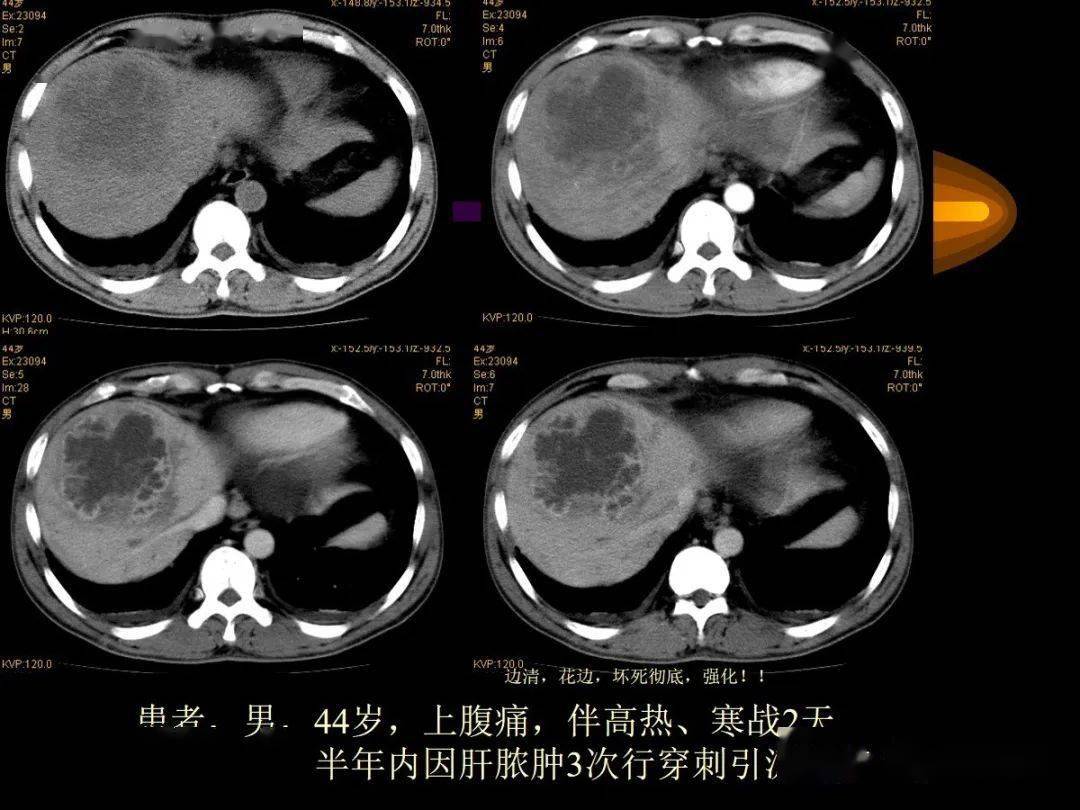 肝内周围型胆管细胞癌的影像特征