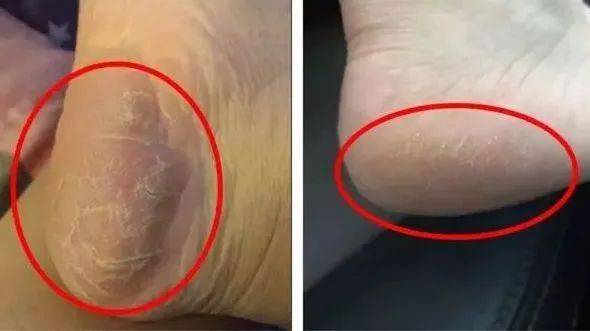 拖鞋|爱穿凉鞋、拖鞋出门的女人,脚上露出这个东西也太丑了吧~