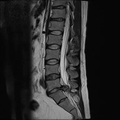 腰椎核磁共振检查(mri)提示l5-s1椎间盘巨大脱出(中央偏右).