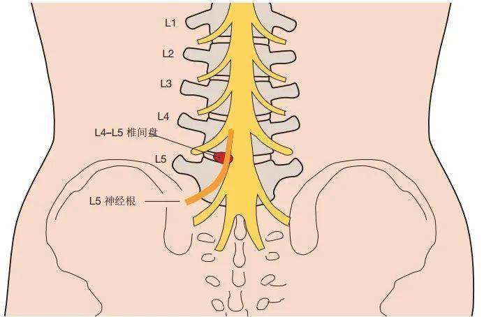 在患者存在l4～l5或l5～s1椎间盘突出因而导致l5或s1神经根受压迫时