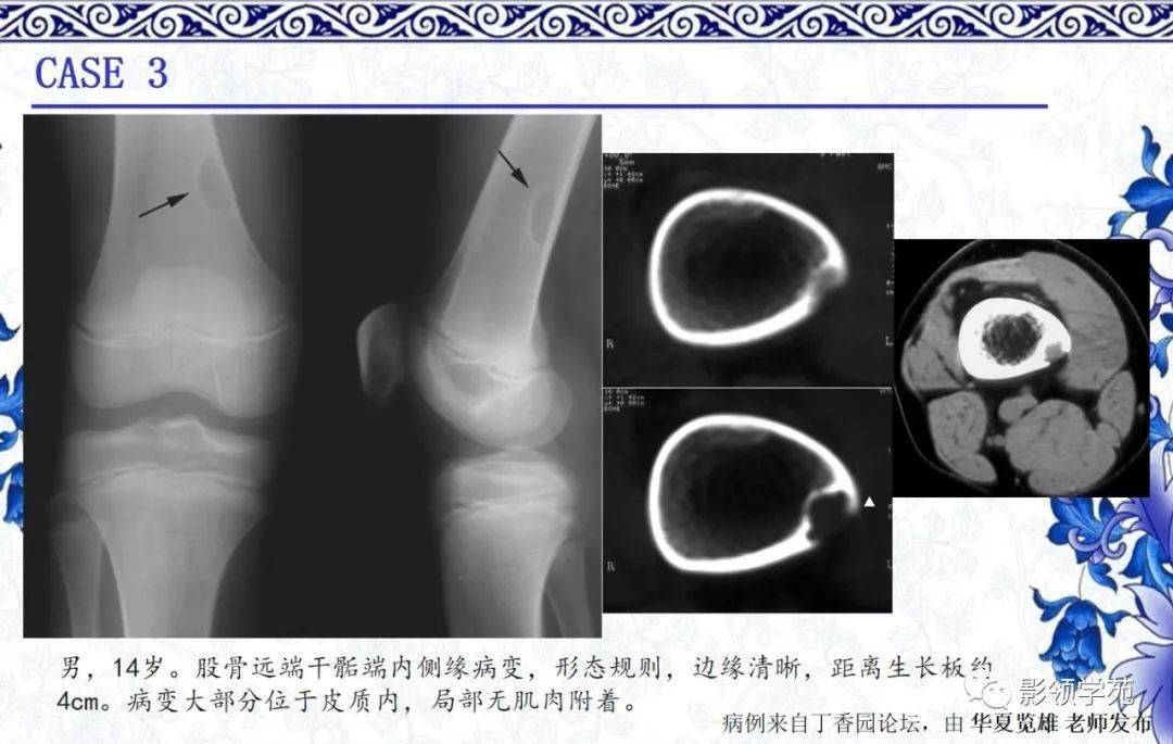 【经典回顾】非骨化性纤维瘤