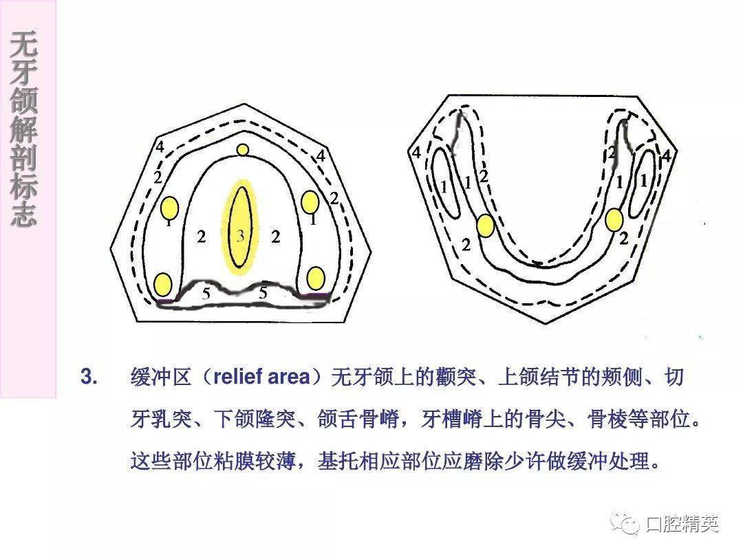 无牙颌解剖标志