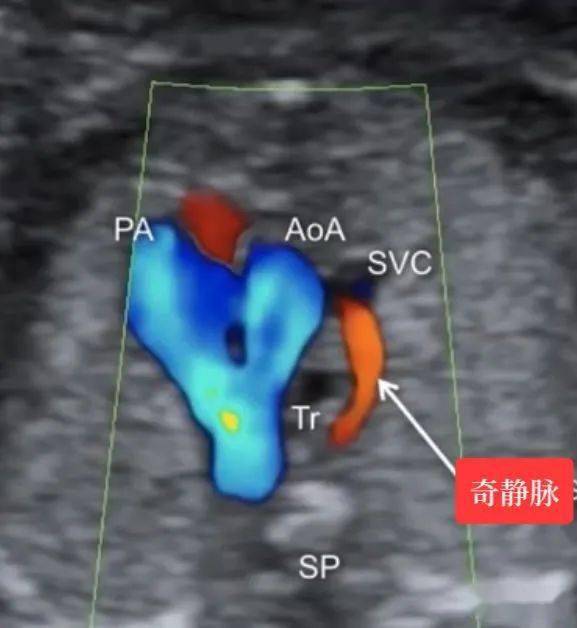 正常篇:三血管气管切面——胎儿心超最重要的切面