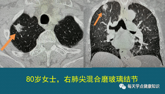 宅在家里无聊,跟医生学ct片吧,肺癌和肺结节好鉴别,5个细节