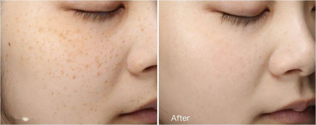 女人|如果你正长“色斑”,试试这个新方法,惊喜到让你尖叫!