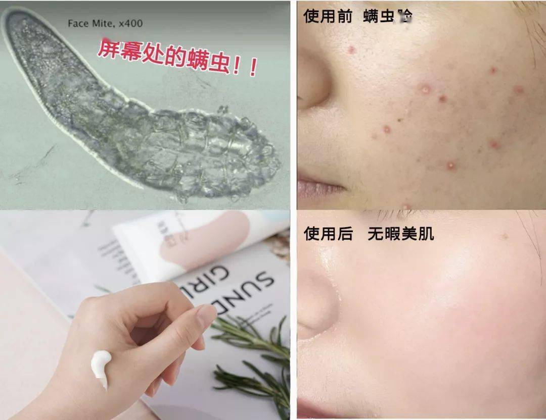 氨基酸|拒绝“螨虫脸”，5秒揉一揉，螨虫全出来了，痘痘黑头全没了！