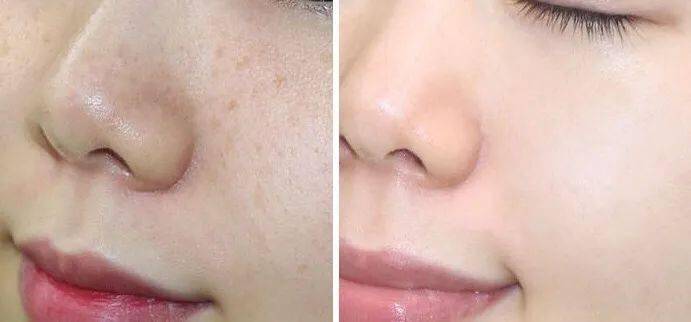 女人|如果你正长“色斑”,试试这个新方法,惊喜到让你尖叫!