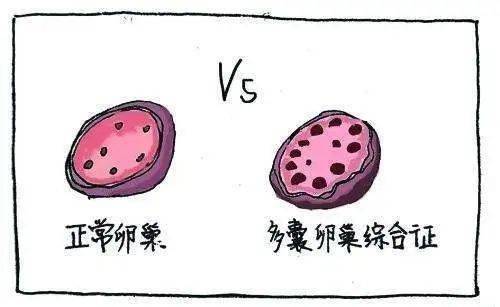 患者|热爱生活，让你远离多囊烦扰