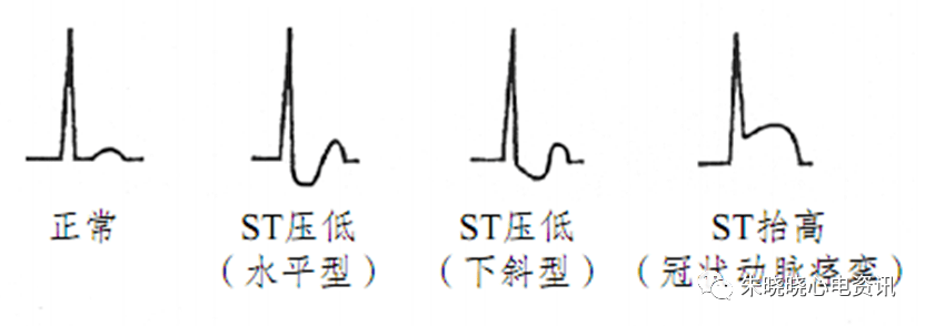 八大病例教你看懂心肌缺血发作时的心电图表现