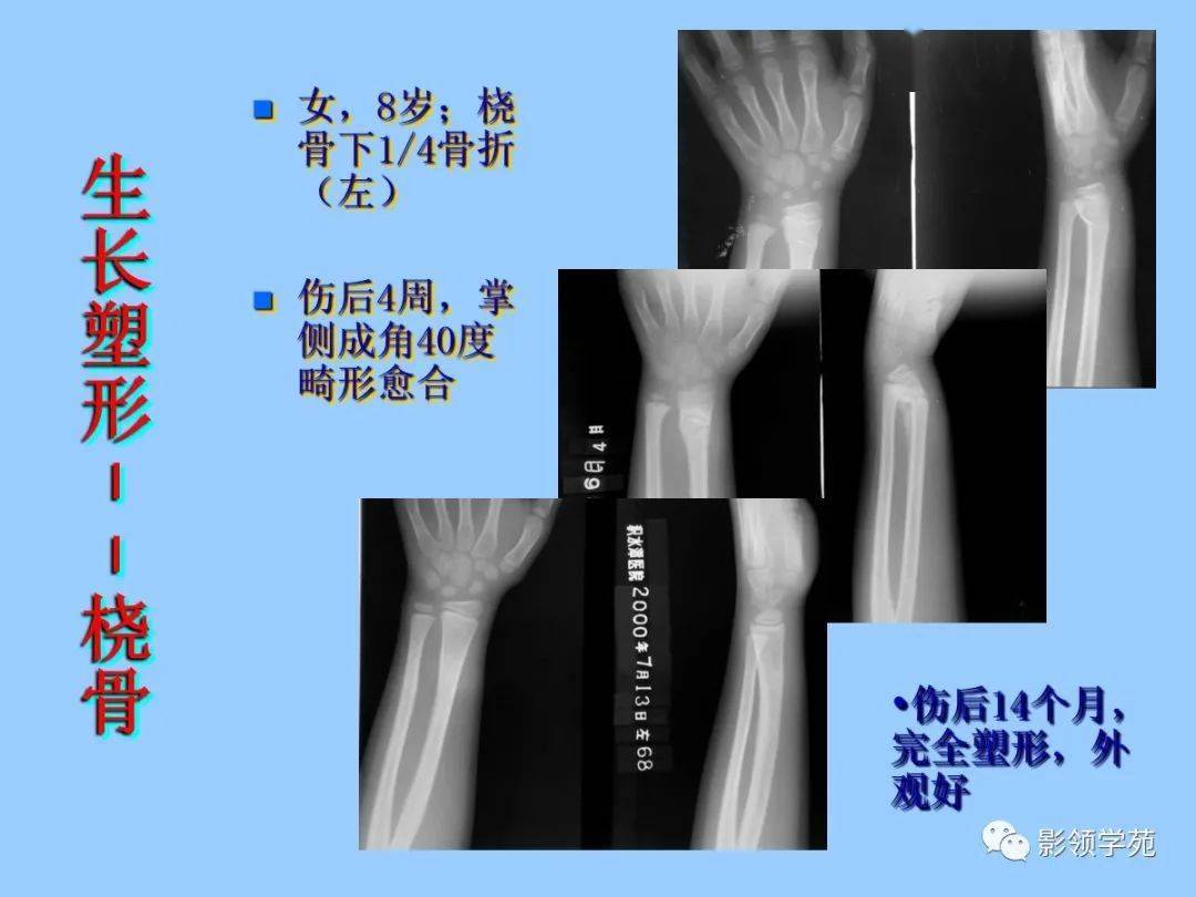 儿童骨折的类型及影像特点