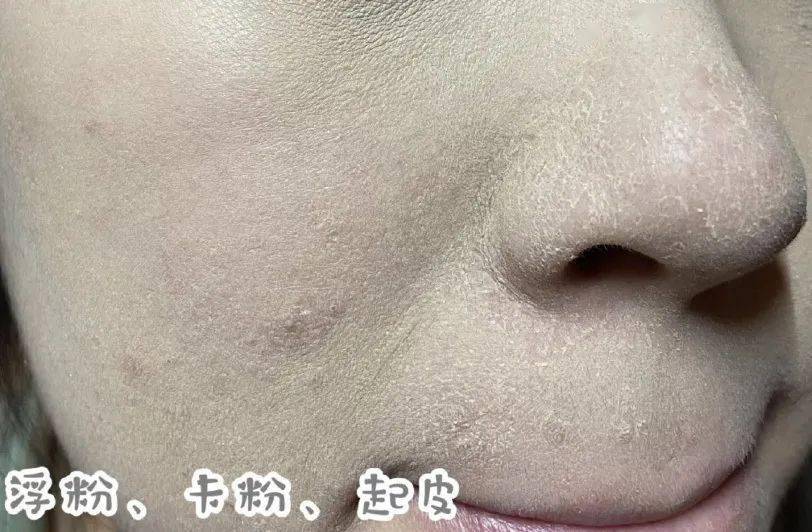 空气变得干燥,皮肤也开始缺水, 久坐空调房 肌肤外油内干,粗糙,翘皮