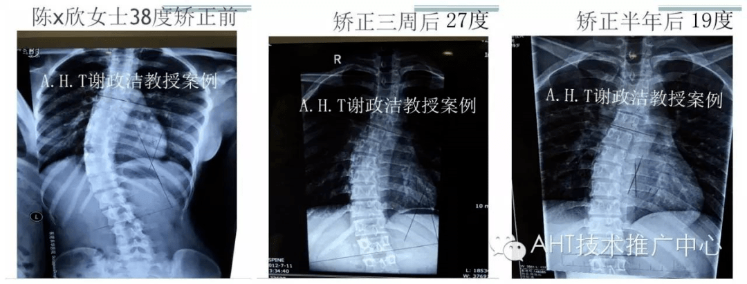 【病例分享】谁说成年脊柱侧弯就无法矫正?谢政洁教授