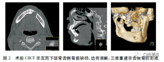 32,33,34,35叩痛(-),颊舌侧牙龈,龈颊沟及下颌骨未触及膨隆.