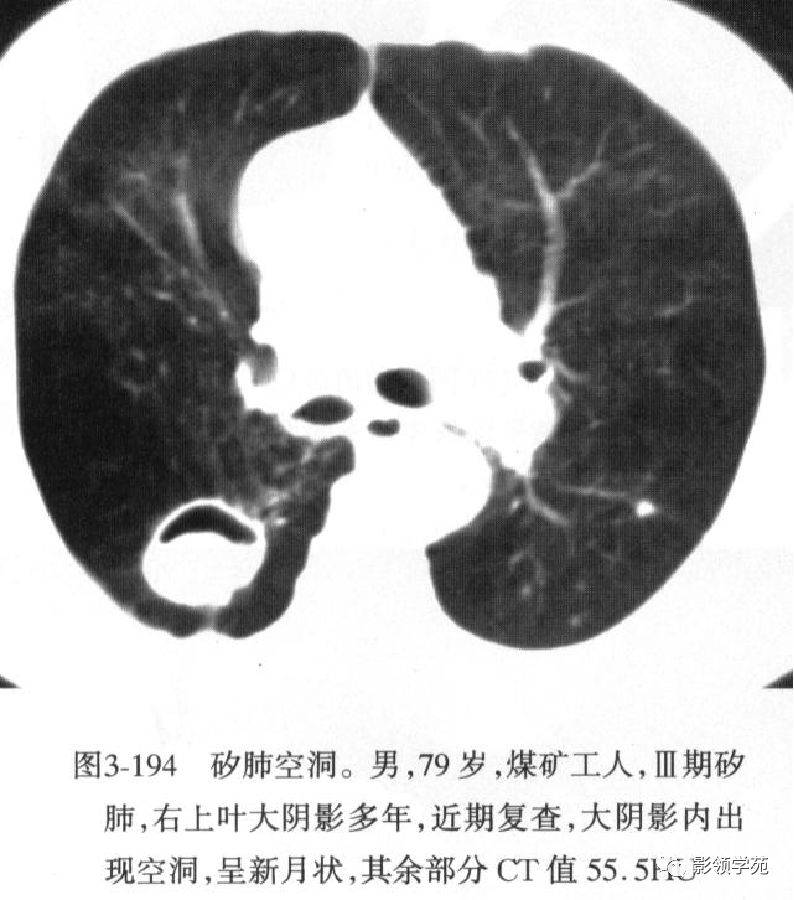 肺部空洞病灶的影像诊断