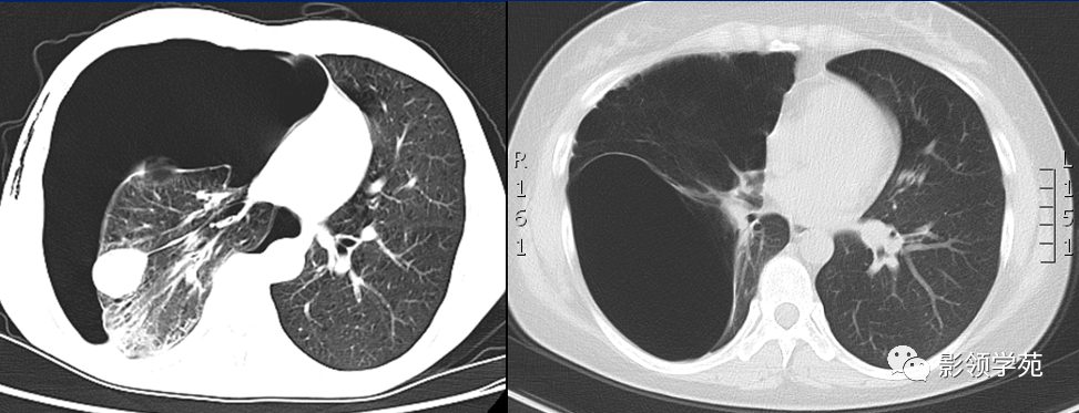 肺大泡影像学诊断及鉴别
