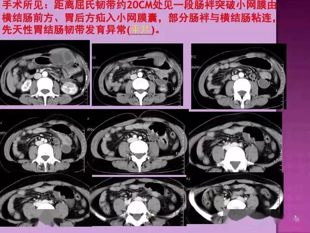 ct上如何寻找肠梗阻的梗阻点