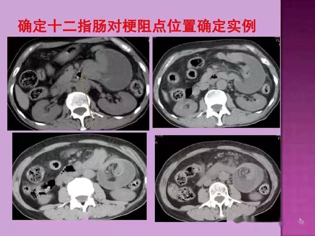 ct上如何寻找肠梗阻的梗阻点