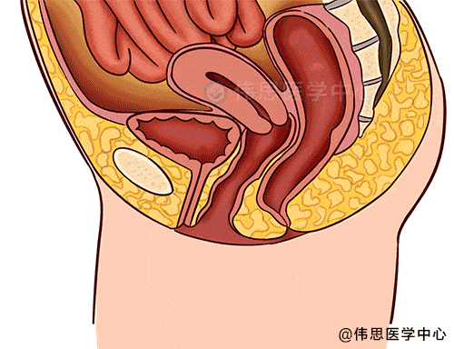 与腰背痛,下腹坠胀感,下体异物感有关阴道后壁膨出,主要导致便秘,排便