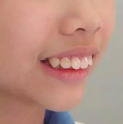 错!这20种儿童牙颌畸形12岁前必须处理!