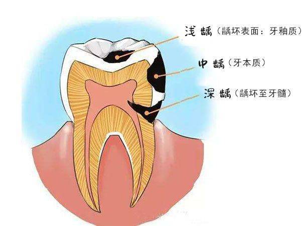 牙齿龋坏过程