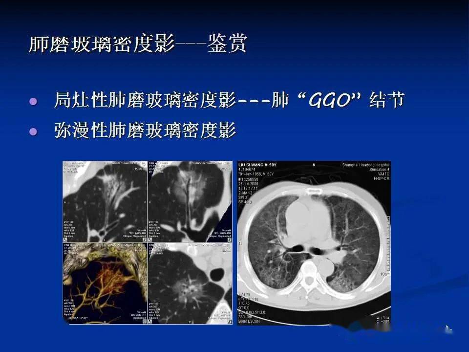 读片基础----肺部弥漫性磨玻璃密度影的影像表现_手机搜狐网