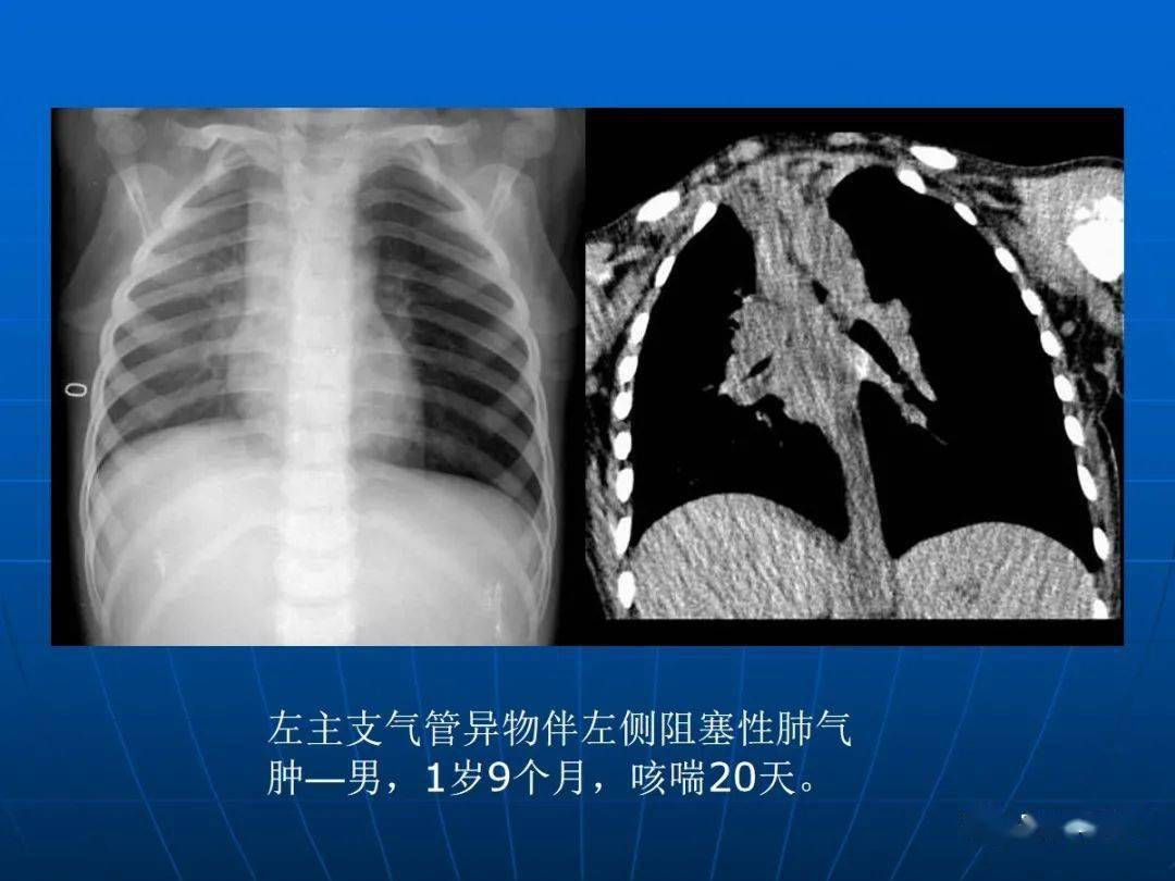 肺气肿的影像诊断