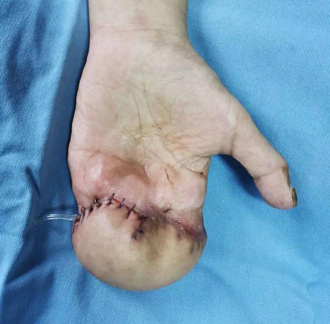 30岁女生面临截肢,专家如何挽救她的手