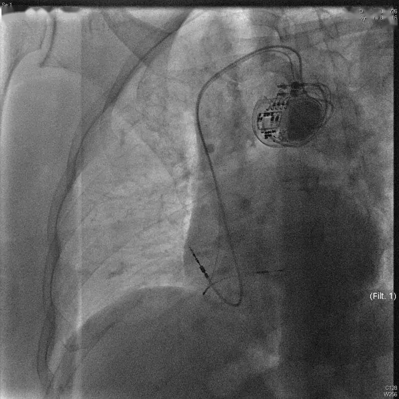 寿命|中国首台！清华长庚心内科植入3.0T核磁兼容长寿命起搏器