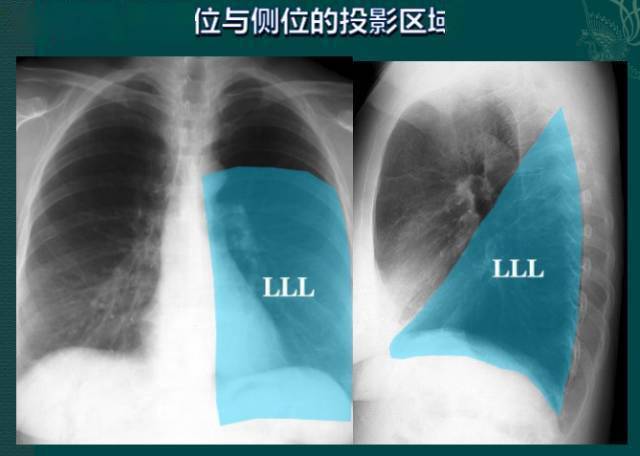 纵隔|读完此文，终于学会看胸片了