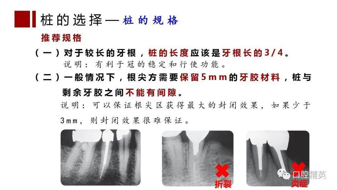 根管治疗桩核选择和桩冠修复