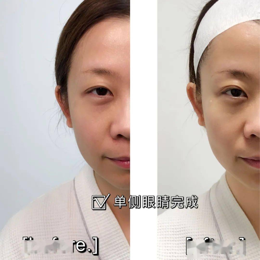 皮肤|热玛吉五代团购第2波丨热玛吉的精髓——眼部450发全纪录