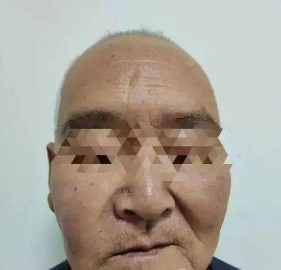 骨体内的锥形空腔,是鼻窦的一个部分,而老刘的鼻窦里竟然长出了牙齿