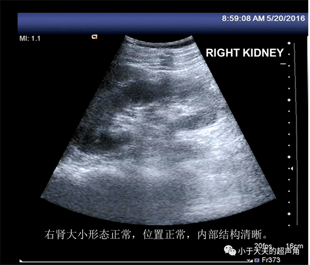 【超声随响】第21期 肾脏先天性发育异常 诊断肾缺如要谨慎!