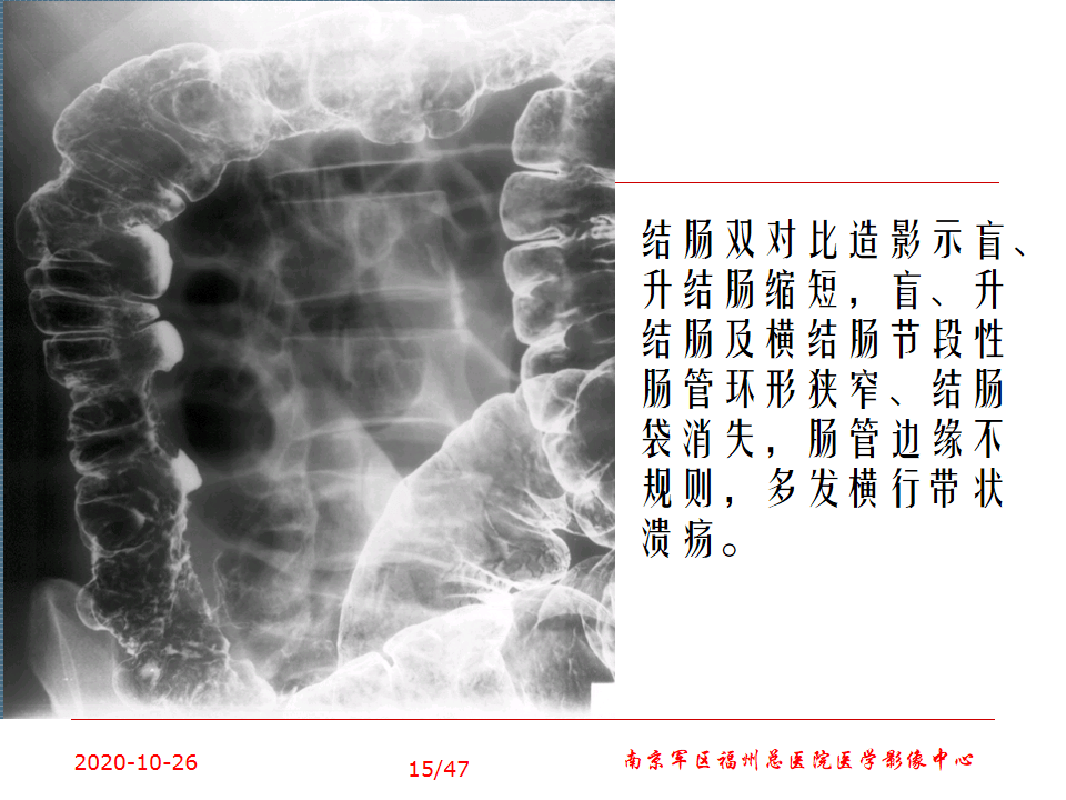 回盲部常见疾病及影像学表现