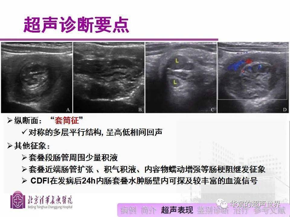 文献学习与病例讨论:儿童肠套叠