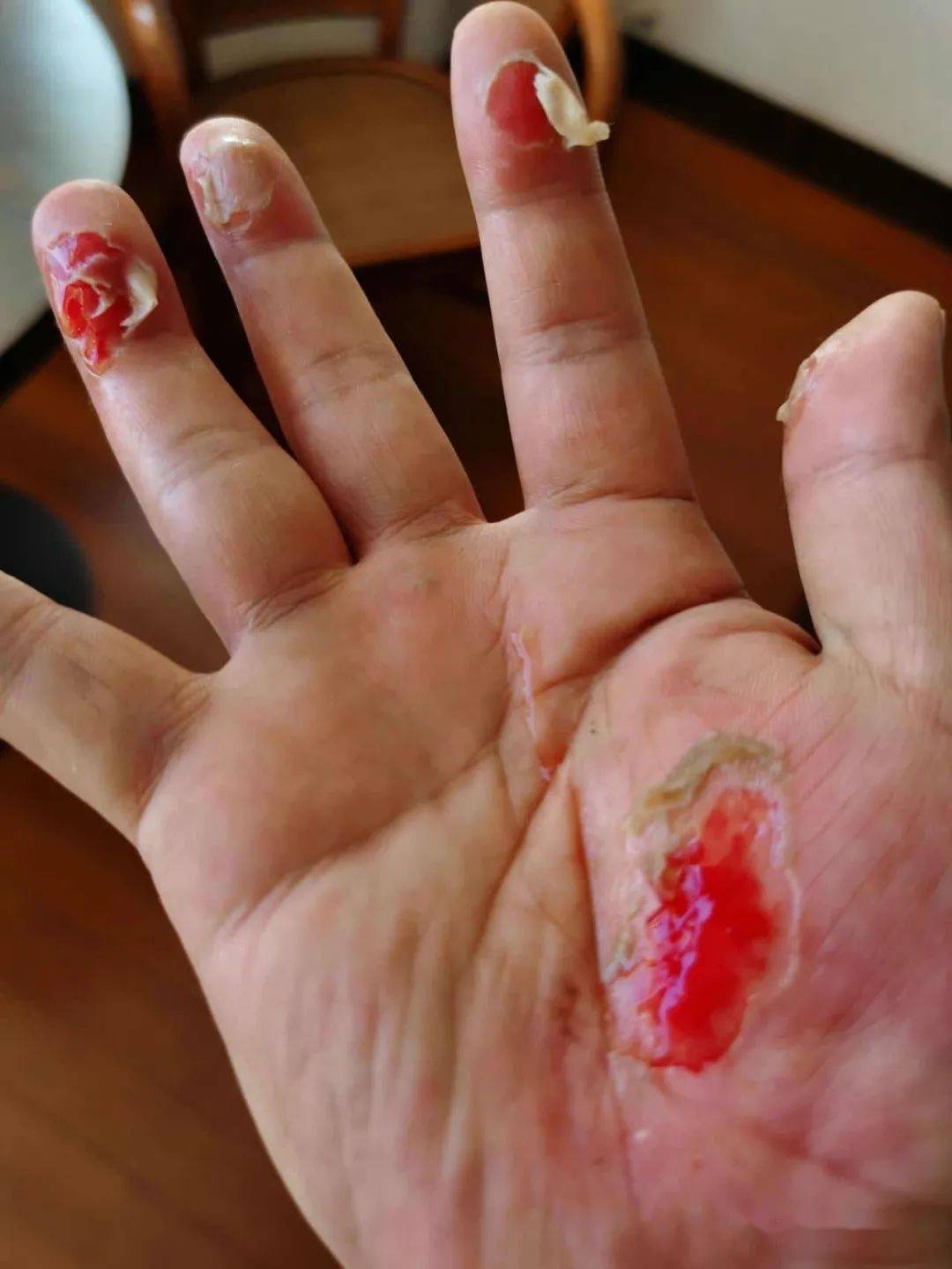 最近,这张图片 图中是一只擦伤严重的右手,手指手心都破了皮,肉裸露