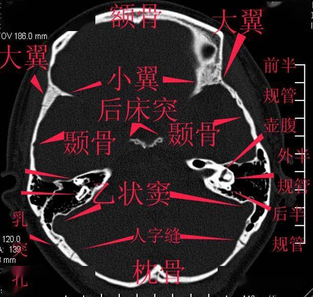 纯手工详细标注的颅底解剖,太赞了!