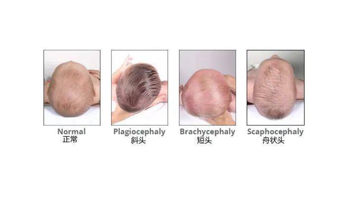 从宝宝的 头顶观察,看孩子头部的形状是不是对称和正常.