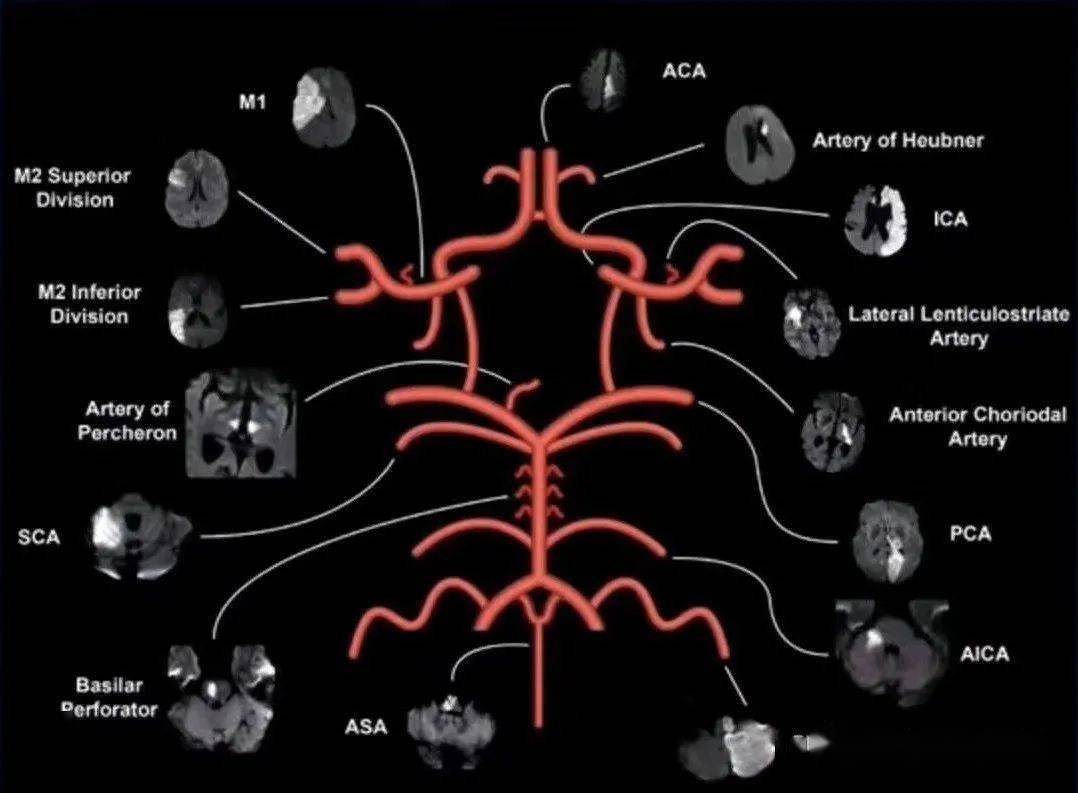 脑血管之当解剖遇到临床