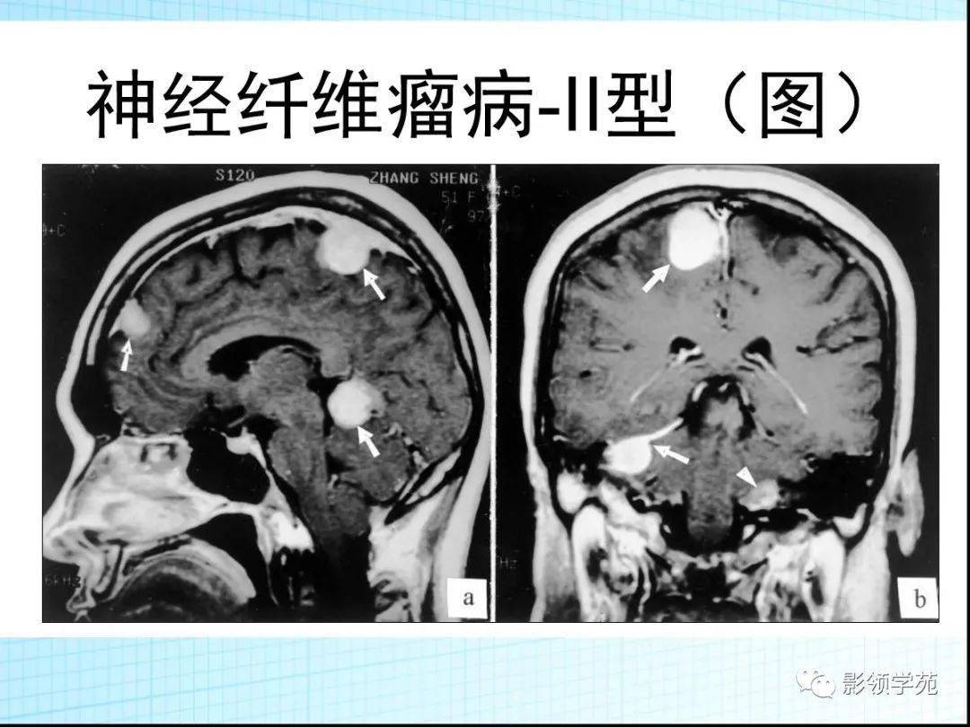 神经纤维瘤病影像表现