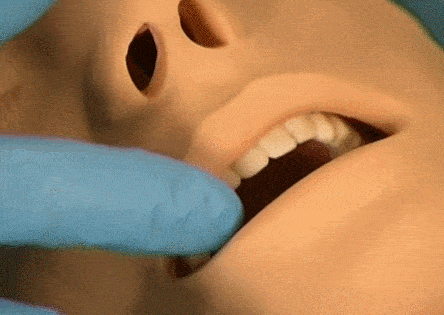 (5)插管前评估:检查患者口腔,牙齿,张口度,颈部活动度,咽喉部情况