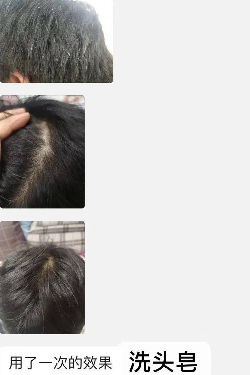 怎么减少头皮出油情况 a24863f56e9040e199063e10bd837170.jpeg