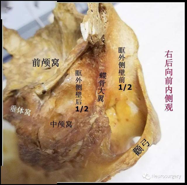 详解翼点入路的头位摆放_蝶骨