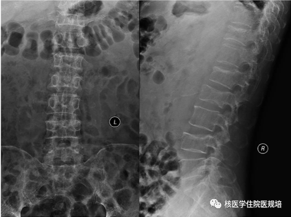 图1. 患者腰椎正侧位x线