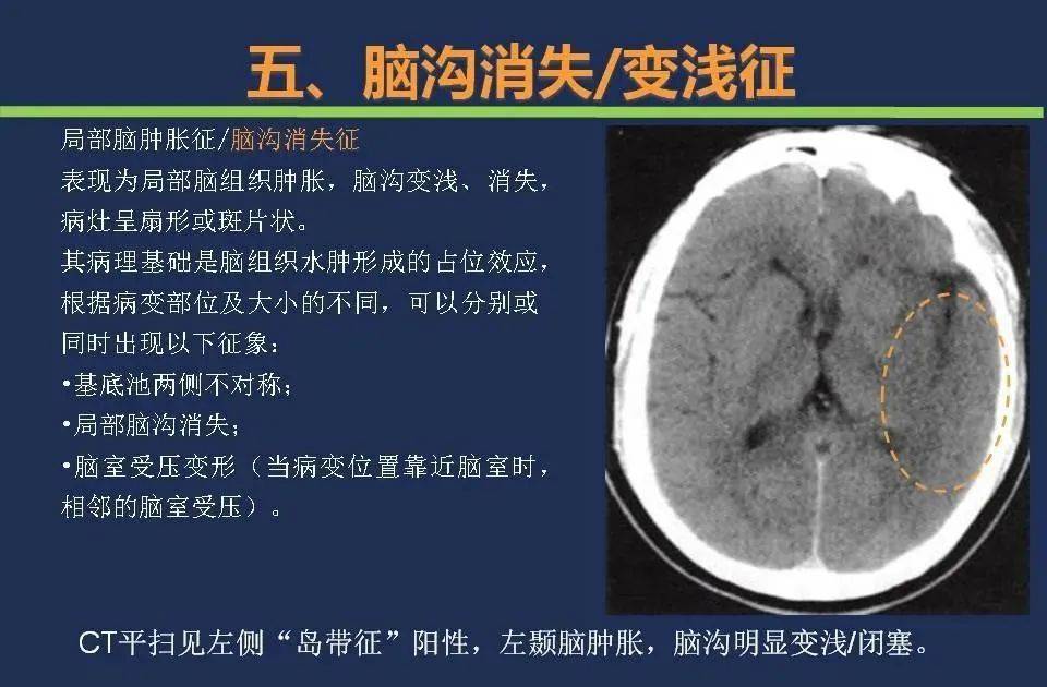 【影像】头颅ct如何预判超早期脑梗死?