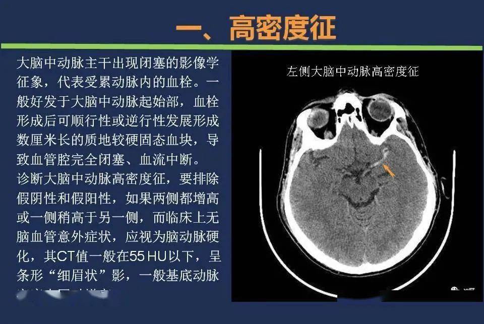 【影像】头颅ct如何预判超早期脑梗死?