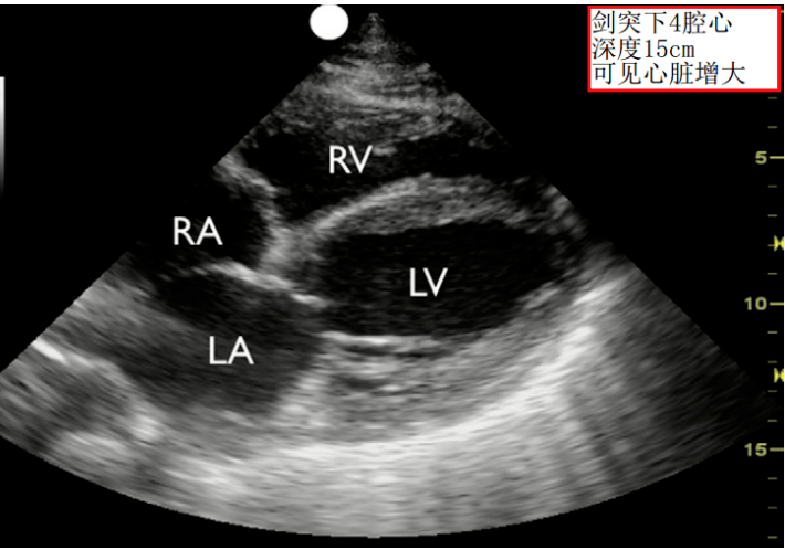 胸骨旁长轴,胸骨旁短轴,剑突下切面,心尖四腔心(见图示)