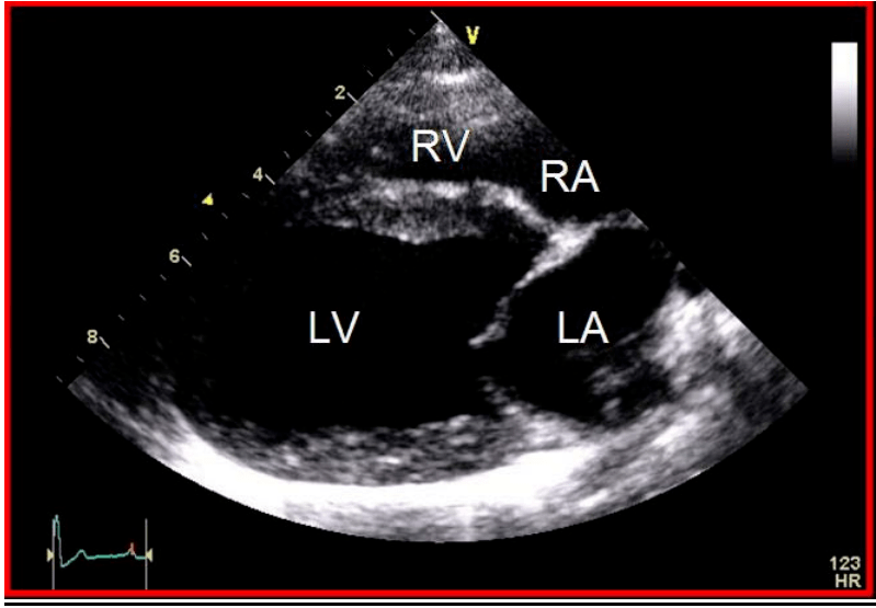胸骨旁右侧四心腔长轴切面