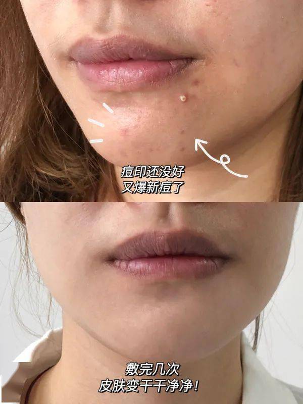 祛痘|长痘几天好不了？学会这招，没有1颗痘活过今晚！